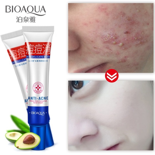 Крем для лечения акне и шрамов Anti-acne